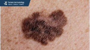 May is Skin Cancer Awareness Month: Let's talk about it. Let's take action. May is Skin Cancer Awareness Month: Let's talk about it. Let's take action.