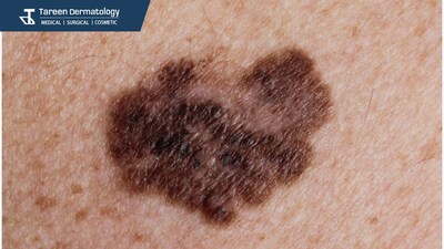 Melanoma is the most serious type of skin cancer. The exact cause of melanoma isn’t clear, but exposure to
ultraviolet (UV) radiation from sunlight or tanning beds increases your risk of developing it.