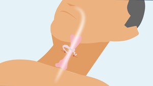 International Surgical Sleep Society Endorses Hyoid Suspension for Sleep Apnea Treatment