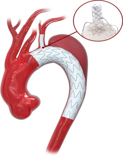 圖：Ankura Plus主體支架和CSkirt裙邊分支支架