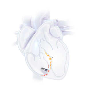 First Commercial Implants of WiSE System for CRT patients