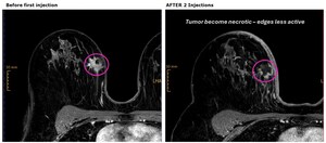 Intensity Therapeutics, Inc. Announces Patients Receiving INT230-6 Prior to the Start of Standard-of-Care May Achieve High Levels of Tumor Necrosis in the Ongoing Randomized Controlled Phase 2 INVINCIBLE-4 Study