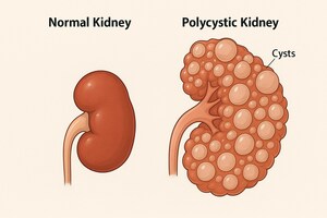 Mezzion Expands Udenafil Pipeline to ADPKD to Target Multi-Billion Dollar Kidney Disease Market