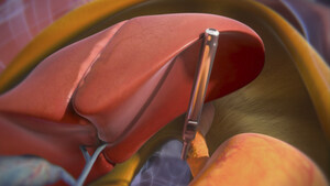 FDA Expands Indication for Levita Magnetics' Magnetic Surgical System with MARS® for Minimally Invasive Bariatric and Hiatal Hernia Repair