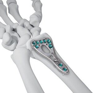 Johnson &amp; Johnson Launches VOLT™ Wrist and Proximal Humerus Plating Systems in the U.S.