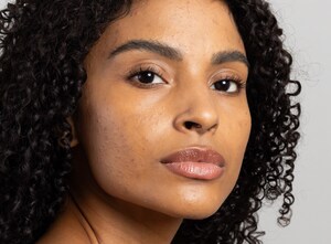 Mês da Acne: conheça os ativos mais eficazes para cuidar da pele acneica