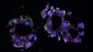 A new "link" to triple-negative breast cancer