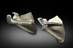 Exactech Announces FDA Clearance of First-to-Market Scapula Reconstruction System for Acromial Stress Fractures