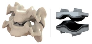 Dymicron Granted IDE Approval for Triadyme-C Artificial Disc