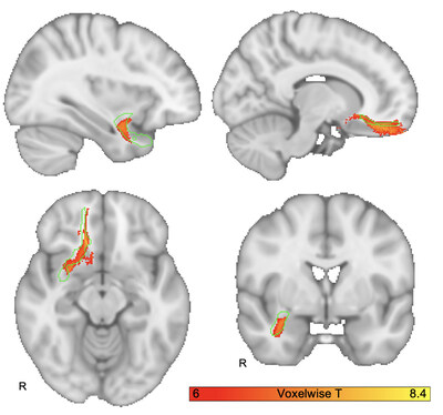 Brain injury to the region of a specific brain connection, the right uncinate, was the most consistent finding among those who developed criminal behavior, particularly violent offenses. -image from Isaiah Kletenik, MD / Brigham and Women’s Hospital.