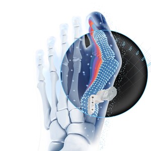 Johnson &amp; Johnson Launches VIRTUGUIDE™ AI-Powered Patient-Matched Lapidus System in U.S. to Reduce Complexity in Bunion Surgery for Millions