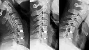 New Findings Underscore Safety and Efficiency of Artificial Disc Replacement in the Outpatient Setting