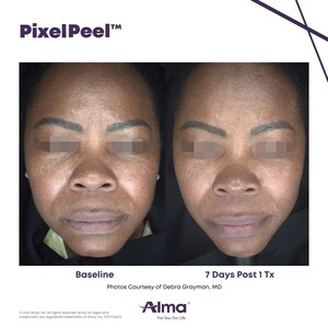 Alma Introduces PixelPeel™: A Smarter, Gentler Approach to Laser Skin Renewal