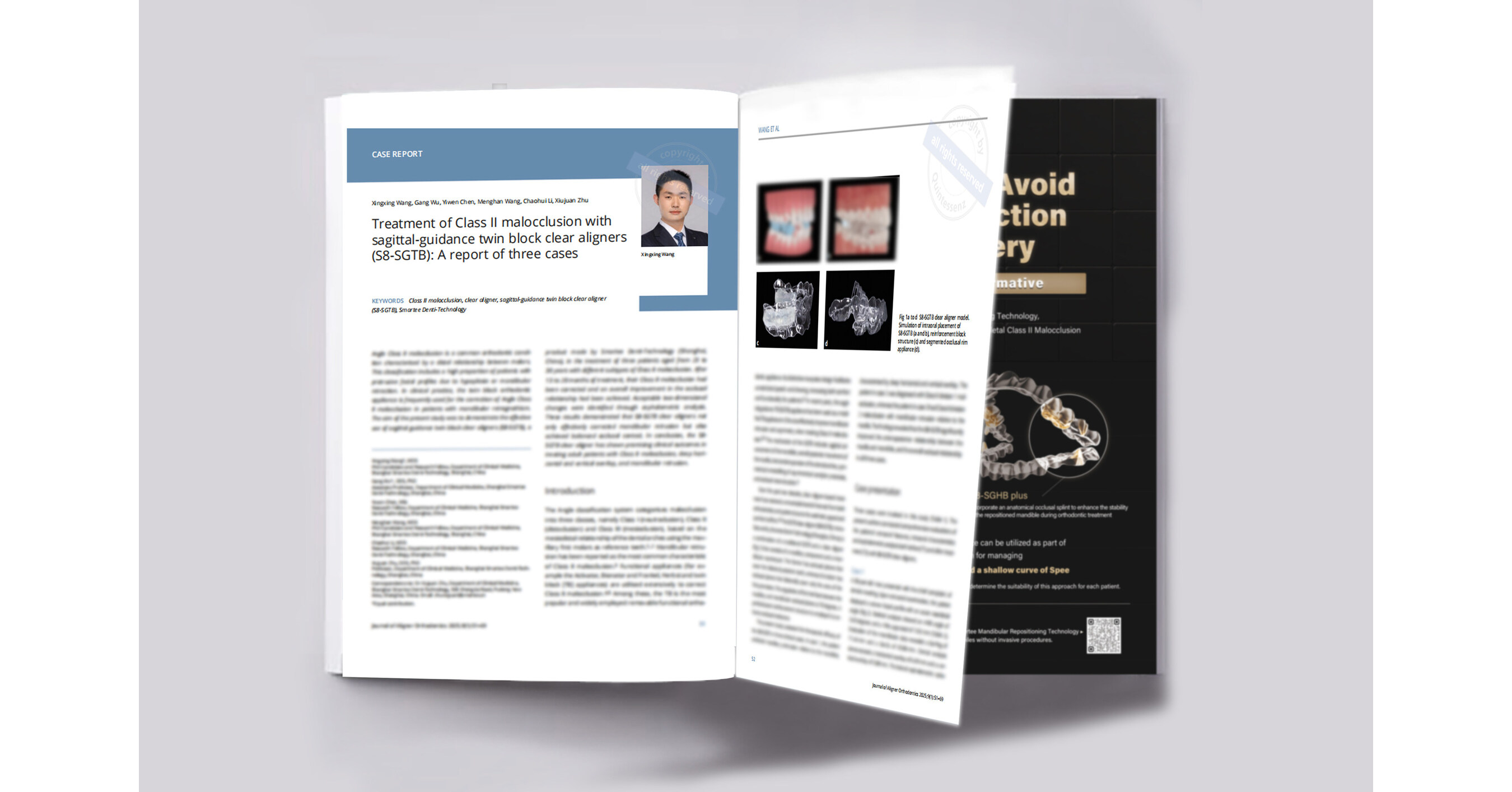 Casos de maloclusi&oacute;n de clase II en adultos tratados con Smartee S8-SGTB publicados en JAO