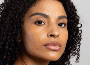 Cuidados de inverno para peles oleosas e com tendência à acne