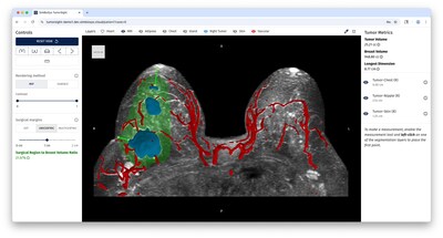 An MRI image seen using the TumorSight™ Viz 3D visualization platform.