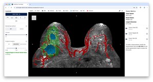 SimBioSys and Ricoh 3D for Healthcare announce strategic alliance expanding access to TumorSight™ Viz for breast cancer surgery