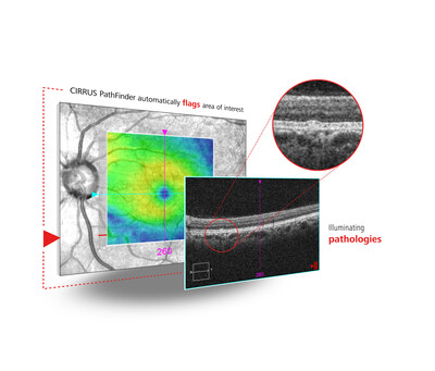 CIRRUS® PathFinder AI-powered OCT assessment too CIRRUS® PathFinder AI-powered OCT assessment too
