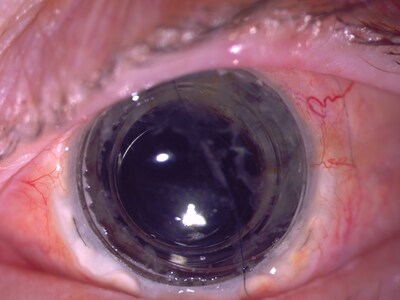 The patient eye following CorNeat KPro implantation 10-month post-op (PRNewsfoto/CorNeat Vision)