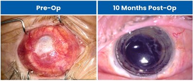 Shingles blinded eye before & after CorNeat KPro implantation (PRNewsfoto/CorNeat Vision)
