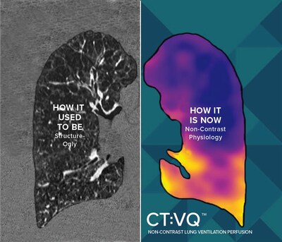 4DMedical CT:VQ™ turns a routine chest CT into ventilation–perfusion imaging—no contrast required. 4DMedical CT:VQ™ turns a routine chest CT into ventilation–perfusion imaging—no contrast required.