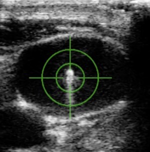 OBVIUS Robotics™ Completes First U.S. Cases with CERTA™ Access System