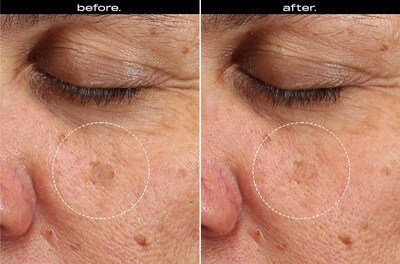 From independent, 12-week clinical trials on 64 participants. This participant used BRIGHTENING + FIRMING SERUM near the end of its 2-year shelf-life. Note the significant improvement in dark spot intensity.