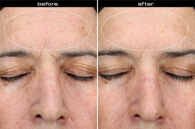 From independent, 12-week clinical studies on 64 participants. This participant used BRIGHTENING + FIRMING SERUM near the end of its 2-year shelf-life. Note the visible improvement in wrinkles across the forehead.