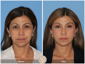 The Future of Facial Rejuvenation is Here: Dr. Kevin Sadati Leads the Charge with the Preservation Facelift