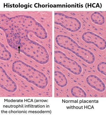 Slides show the difference between placenta tissue affected by chorioamnionitis (left) and normal tissue (right). Source: Cincinnati Children's
