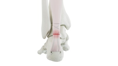 FORCECORD is constructed from a densely woven, tubular, synthetic, non-resorbable polyester. The implant features flat tapered ends and uses a specially designed probe for ease of passing. When combined with Medline UNITE’s DEXLOCK® Knotless Suture Anchors, the system is intended to offer repair through a streamlined technique.