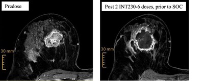 Patients being treated with INT230-6 continue to show significant necrosis after two doses of INT230-6 and prior to the initiation of the SOC, as shown in the photos below of a single patient’s breast tumor scans