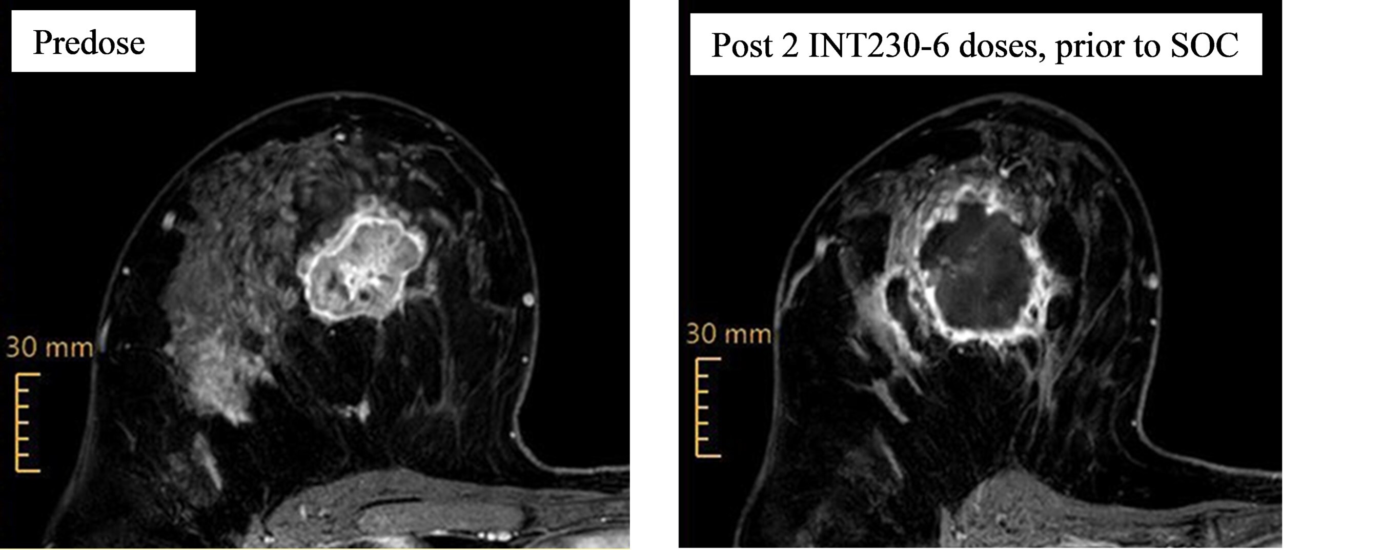 Intensity Therapeutics Reports INVINCIBLE-4, Presurgical Triple-Negative Breast Cancer Study Update