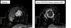 Intensity Therapeutics Reports INVINCIBLE-4, Presurgical Triple-Negative Breast Cancer Study Update