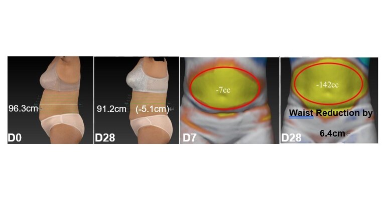 ImmVira Announces First-in-Human Data of Engineered Exosome MVR-EX105 for Fat Reduction and Muscle Preservation by Topical Application at 2025 Annual Congress of the International Federation for the Surgery of Obesity and Metabolic Disorder