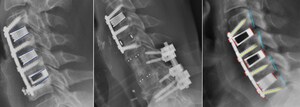 Nexus Spine's Patented Tranquil® Interbody Implants Achieve Exceptional Outcomes