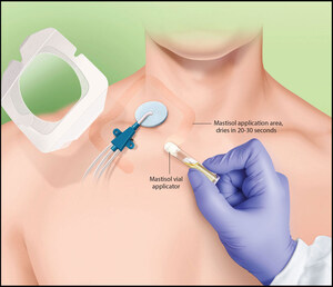 New ICU Study Finds Simple Adhesive Step Cuts Jugular Line Dressing Failures Nearly in Half