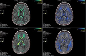 Myrtelle Announces Nature Medicine Publication of Interim Results from Its Phase 1/2 Clinical Trial of Investigational Gene Therapy rAAV-Olig001-ASPA for Canavan Disease