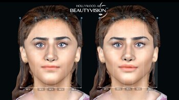 Before and after results using AI BeautyVision™ at Doha Hollywood Clinic