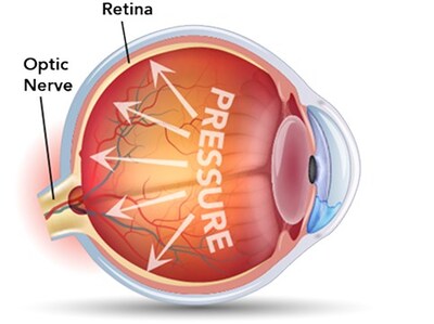 Retina and Optic Neve pressure from