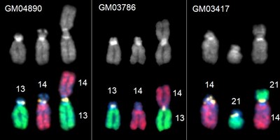 This image shows Robertsonian fusion chromosomes and their normal, non-fused counterparts from three different human cell lines. Chromosomes are labeled by fluorescence in situ hybridization (FISH) with whole chromosome paints denoting chromosome 14 in red, chromosomes 13 and 21 in green, and SST1 repeat probe in yellow, highlighting the fusion point of the Robertsonian chromosomes.