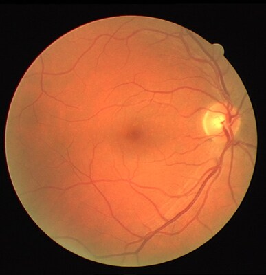 An image from a retinal scan captures the eye’s blood vessels and veins. (CNW Group/St. Joseph's Healthcare Foundation)