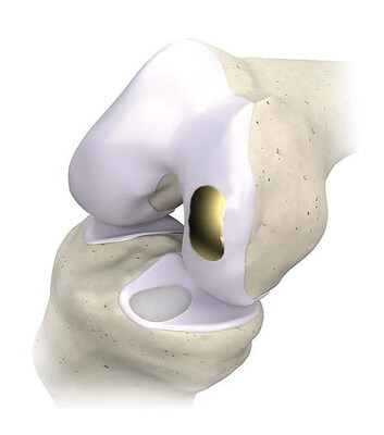 OvertureTi Knee Resurfacing System® - femoral and tibial components. The implants’ baseplates are 3D printed, porous titanium to promote osseointegration and solid fixation. Articulating surfaces for the femoral and tibial components are titanium nitride, and an overmolded Vitamin E treated, highly crosslinked polyethylene, respectively.