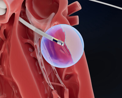 Field Medical: Engineered to reach the epicardium from the endocardium, the FieldForce Ablation System catheter is designed to enable focal pulsed field ablation for full-thickness, transmural lesions. Field Medical: Engineered to reach the epicardium from the endocardium, the FieldForce Ablation System catheter is designed to enable focal pulsed field ablation for full-thickness, transmural lesions.