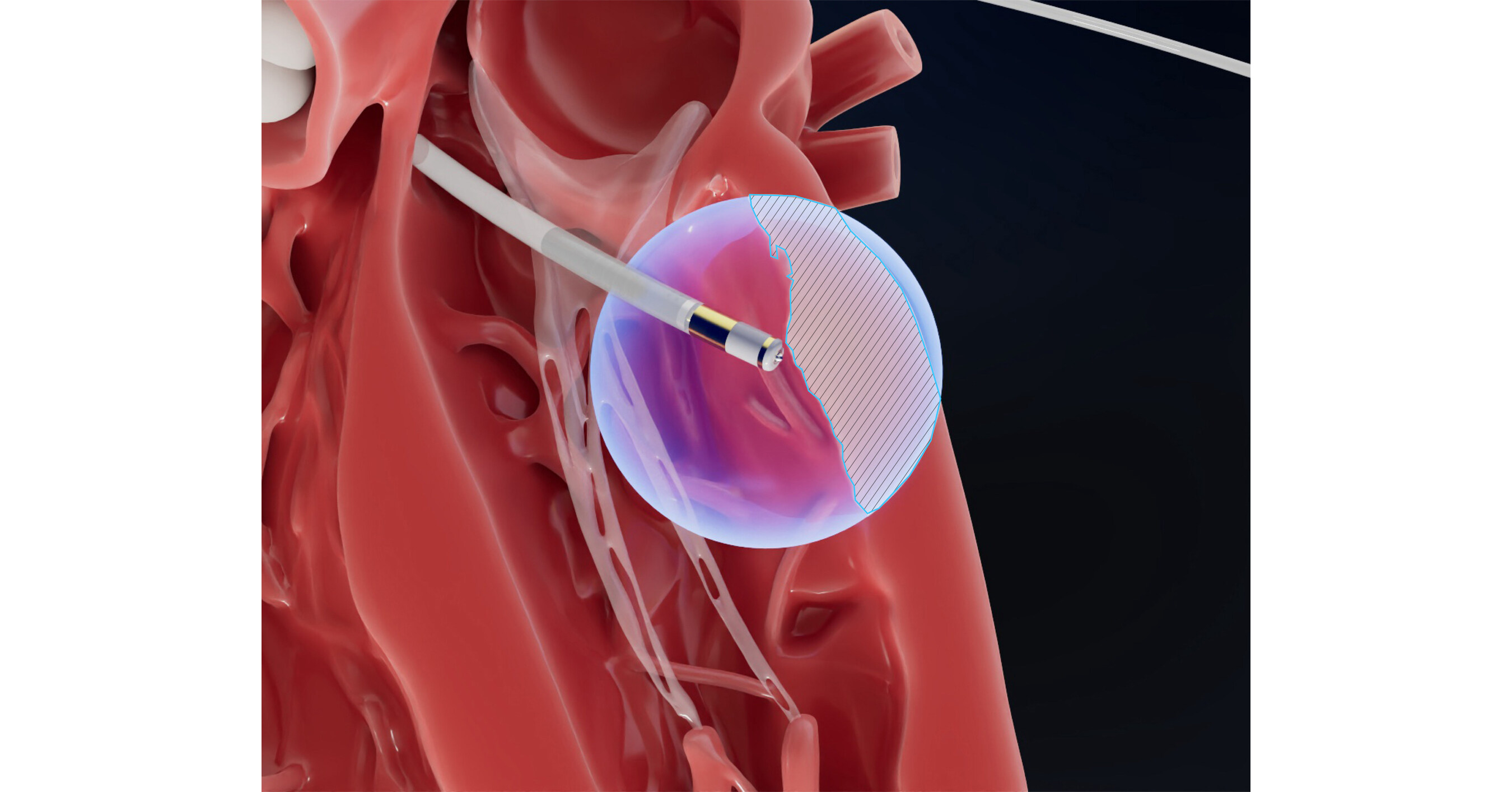 Field Medical Presents Positive 6-Month First-in-Human Data for PFA System in Ventricular Tachycardia post image