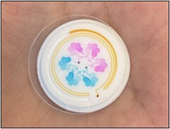 Researchers have developed a flexible, skin-mounted 3D microfluidic device capable of analyzing sweat for real-time health assessment.