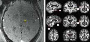 Queen Square Imaging Centre: New technique could improve outcomes for essential tremor patients