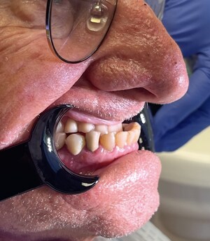 Ridgewood Dentist Unveils Groundbreaking Two-Visit Underbite Correction Method