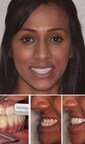 Underbite Correction without Jaw Surgery