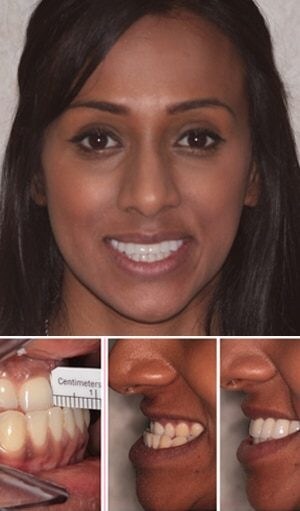 Underbite Correction without Jaw Surgery